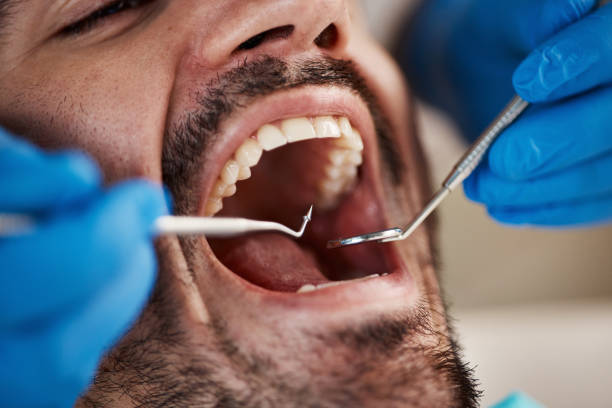 Best Emergency Dentist for Lost Fillings or Crowns in Armada, MI